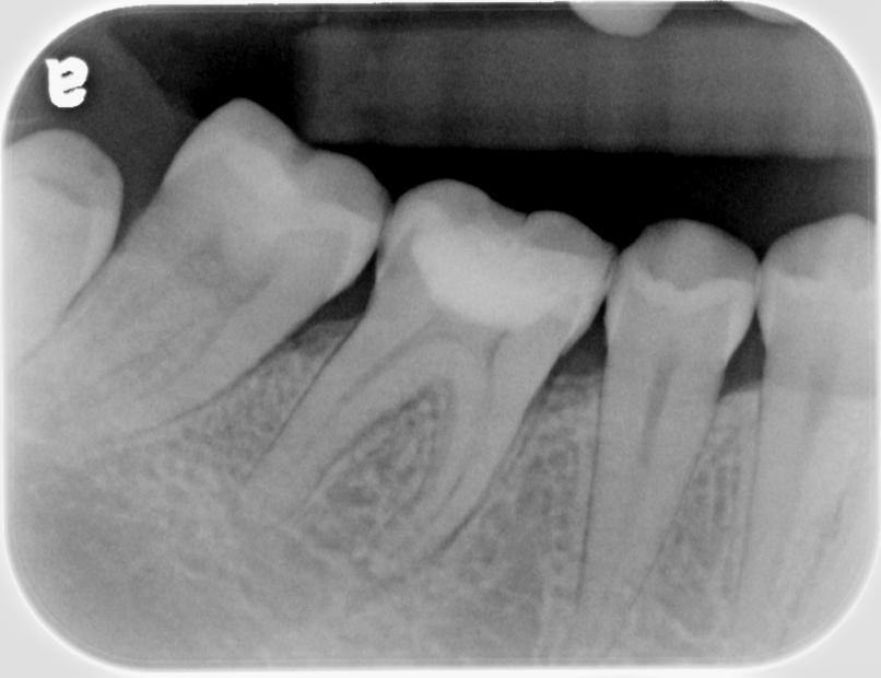 Periapical X Ray Cone Beam Ct Scan Cbct Lesion Of End - vrogue.co