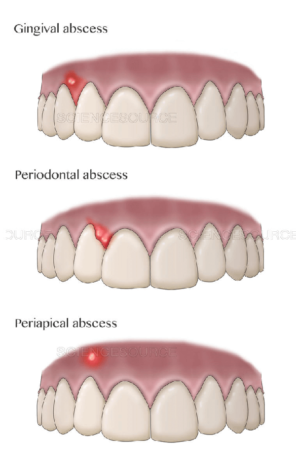 Tooth Abscess Drainage