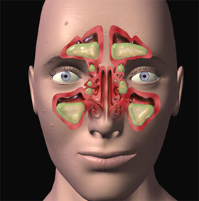 Inflammation des sinus (sinusite)