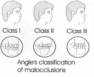 angle-classification