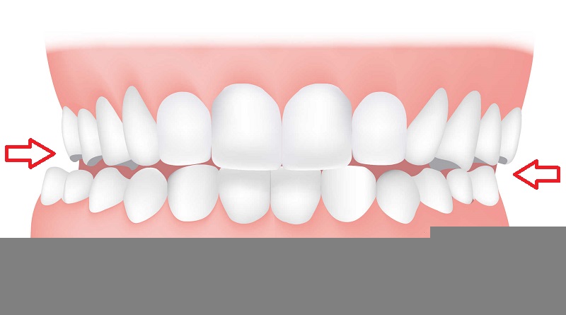 crossbite orthodontic treatment in manila philippines