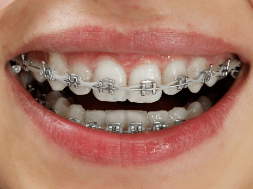 braces