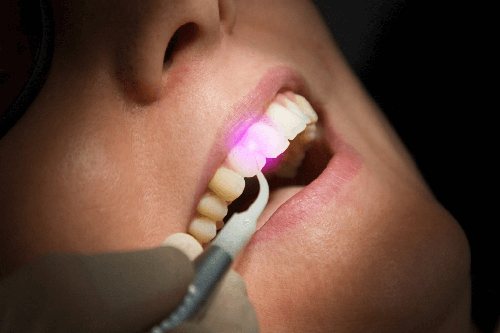 dental-laser1