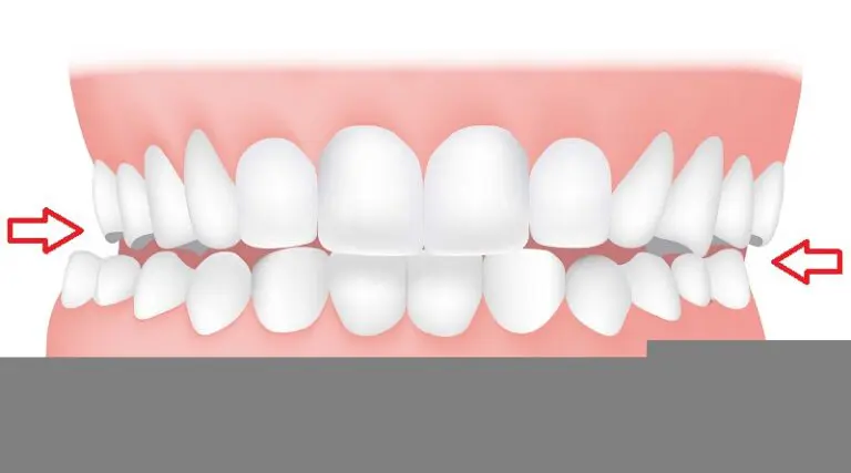 Crossbite orthodontic treatment