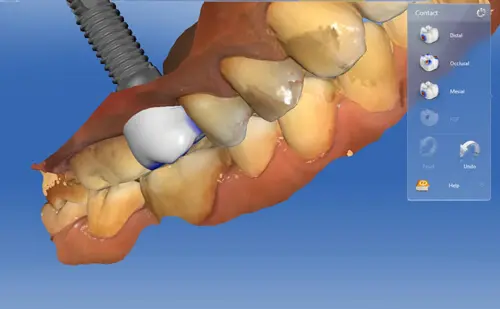 Tooth Preparation