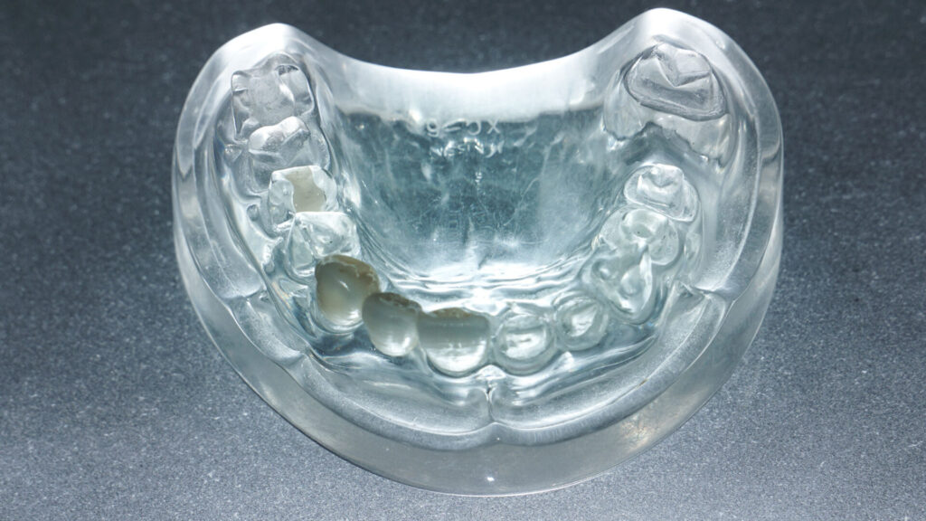 Dental bridges for smile restoration