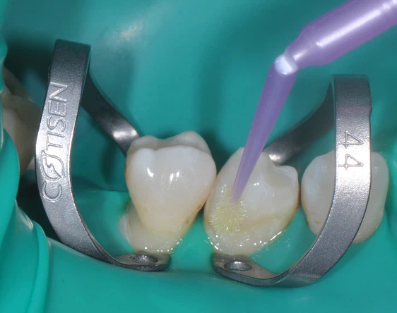 Endodontic irrigation procedure