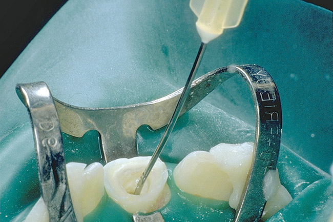 Endodontic Treatment