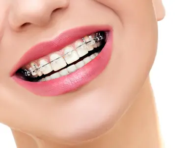 Fixed orthodontic appliances and braces