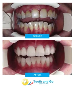 Full mouth reconstruction dental