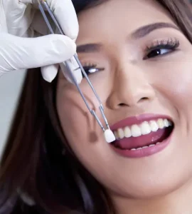 Smile makeover crowns and dental veneers in Manila, Philippines