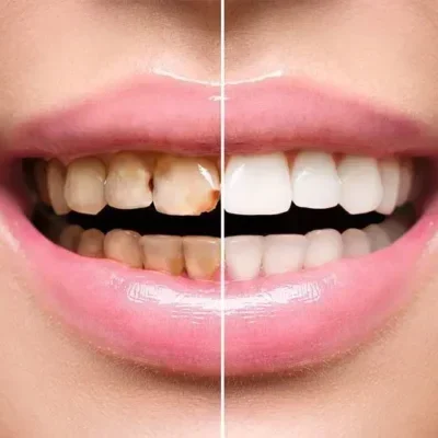 Teeth Bleaching Procedures Manila