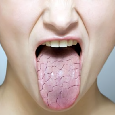dry-mouth